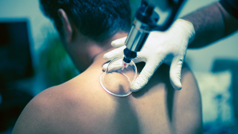 Demystifying Cupping Therapy