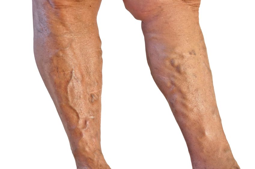 Discover Vein Clinics of Schaumburg