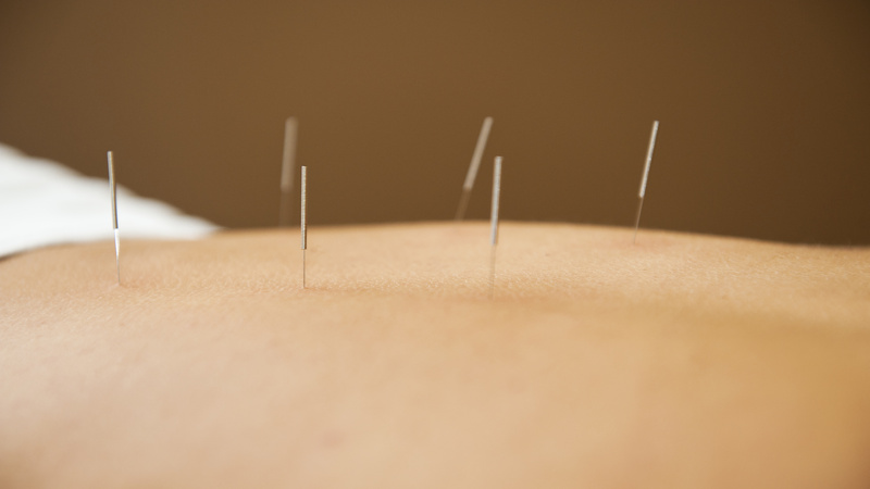 Relieve Chronic Discomfort Naturally With Acupuncture For Pain Bellingham, WA Solutions