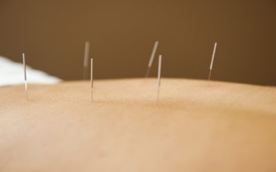 Relieving Chronic Discomfort with Acupuncture For Pain Management in Berkeley, CA: Success Stories